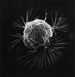 A breast cancer cell.