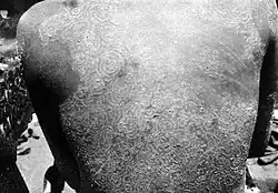 Scaly patches on human back.