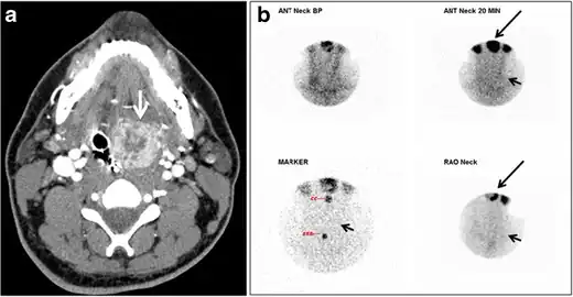 Fig. 18. Lingular thyroid in a 33-year-old male who presented with oropharyngeal bleeding. an Axial enhanced neck CT scan at the level of mandible demonstrates a 3 × 3 × 3.4&nbsp;cm round, partly well-delineated, heterogeneously enhancing lesion (white arrow). It is predominantly on the left side of the oropharynx and to some extent at the mid part of the base of the tongue. The thyroid gland was normal (not shown). b Image of the anterior face and neck taken 20 minutes after Tc99m-Pertechnetate injection shows absent thyroid radiotracer uptake in normal thyroid anatomical location (black short arrows). There is an area of increased uptake (long black arrows) corresponding to the posterior tongue mass identified on CT scan.[1]