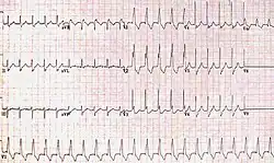 RBBB with associated tachycardia