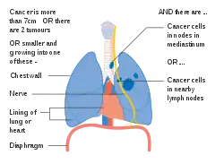 Stage IIIA lung cancer, if there is one feature from the list on each side