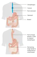 An esophagectomy using the bowel (colon) to replace the esophagus
