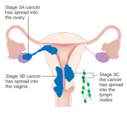 A diagram of stage III endometrial cancer