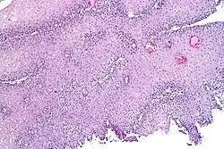 Histopathology of GERD