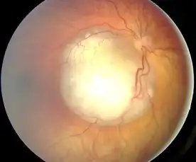 Ocular fundus aspect of retinoblastoma