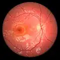 Fundoscopy, right eye of a 5-year-old boy with HJMD