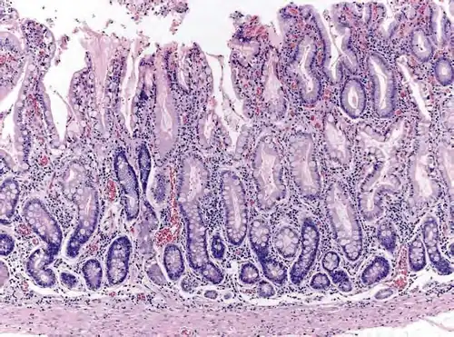 Histopathology of antral mucosa with atrophy. H&E 10x. Antral gastric mucosa with accentuated atrophy because of replacement by extensive intestinal metaplasia.