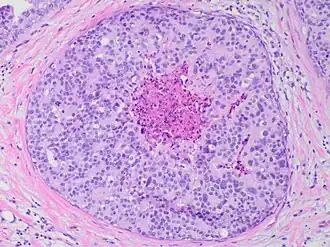 Ductal carcinoma in situ with comedo necrosis spanning 30% of its diameter, which is generally regarded as the minimal size to classify it as comedo.[27]