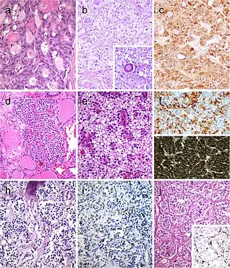 Follicular patterned medullary thyroid carcinoma (MTC) (a). In this other follicular patterned MTC (b), there are several calcifications simulating psammoma bodies (inset) and positivity for calcitonin (c). Intrathyroidal parathyroid tissue (d). The microscopic aspect of an intrathyroidal parathyroid adenoma is similar to eutopic parathyroid adenomas (e). Intrathyroidal parathyroid adenoma expressing chromogranin A (f) and PTH (g). Calcitonin-negative medullary thyroid carcinoma (h) showing positivity for CGRP (i). Paraganglioma (j) typically shows negativity for calcitonin and S100-positive sustentacular cells (inset)[9]