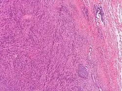 This image was originally posted to Flickr by Pulmonary Pathology at https://flickr.com/photos/30950973@N03/5601450952 (archive). It was reviewed on 3 October 2019 by FlickreviewR 2 and was confirmed to be licensed under the terms of the cc-by-sa-2.0.