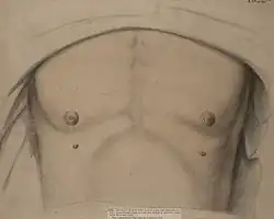Drawing of a man with supernumerary nipples
