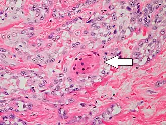 Poorly differentiated clear-cell squamous-cell carcinoma. For this type of cSCC, immunostains will likely be required to classify it unless other areas of the tumor show obvious squamous-cell features, such as seen here (arrow).