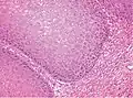 High magnification. There is prominent acanthosis. The tumor front is broad-based and pushes the subepithelial tissues.[10]