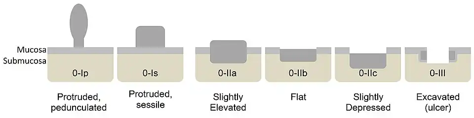 Paris classification of colorectal neoplasms.