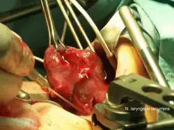 An image of a surgical procedure in which the recurrent laryngeal nerve is visible