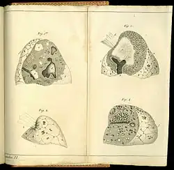 De l'auscultation médiate&nbsp;... Most of the plates in his book illustrate the diseased lung as do these four images that are consistent with lungs affected by tuberculosis.
