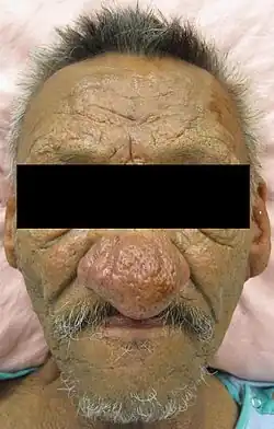 Adult male with a large, red, bulbous nose