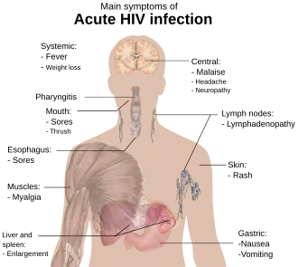 A diagram of a human torso labelled with the most common symptoms of an acute HIV infection
