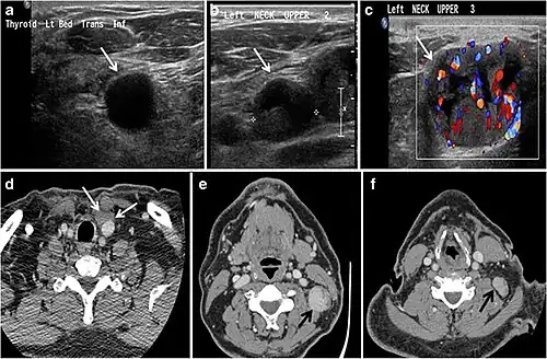Fig. 9. A 58-year-old male patient with persistence PTC at thyroid bed with hypervascular nodal metastasis. a–c Transverse greyscale and colour Doppler neck ultrasound demonstrate hypoehoic soft tissue in the left thyroid bed (white arrow in a). There are a heterogeneous enlarged lymph nodes at level 2 and 3 with markedly increased vascularity (white arrow in b and c). d–f Enhanced axial CT images of the neck demonstrate a 2.7 × 1.4&nbsp;cm hypodense soft tissue lesion anterior to the left carotid sheath (white arrow). There are left-sided enhancing abnormal and enlarged lymph nodes at cervical level 2 and 3 (black arrows).[1]