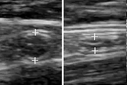 A normal appendix without and with compression. Absence of compressibility indicates appendicitis.[100]