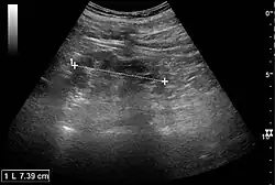 Chronic pyelonephritis with reduced kidney size and focal cortical thinning. Measurement of kidney length on the US image is illustrated by ‘+’ and a dashed line.[20]