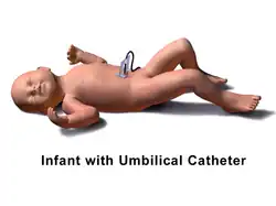 Infant with umbilical catheter
