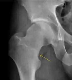 Stress femoral neck fracture in a young athlete barely visible in X-ray film as a sclerotic line (arrow)[1]